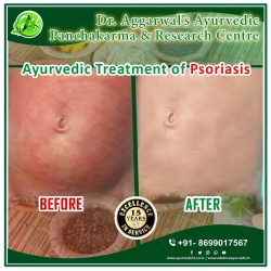 Ayurvedic Treatment for Psoriasis