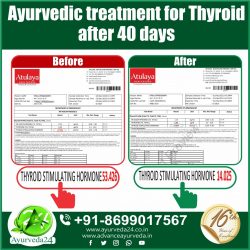 Ayurvedic Medicine for Thyroid