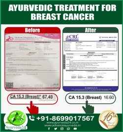 Ayurvedic Treatment for Breast Cancer