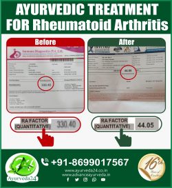 Ayurveda Treatment for Rheumatoid Arthritis.