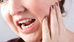 What are Dental Caries (Tooth Decay) | Dental Sealants