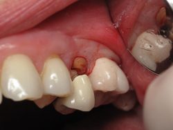 Chipped or Cracked Tooth Causes and Repair | Dental Fillings
