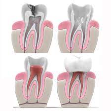 Root Canal Service Near Me | Emergency Root Canal After Care