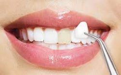 Porcelain Dental Veneers Near Me | Dental Lumineers Treatment Houston