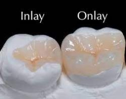 Professional Teeth Whitening | Inlays and Onlays | Implant Restorations