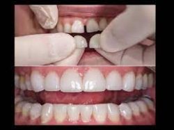 Why Do I Need Dental Veneers? | Prepping Your Teeth for Dental Veneers