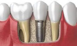 5 Reasons Why Dental Implants Are So Popular -Sapphiresmiles Dentistry
