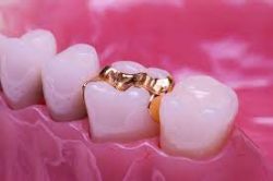 What are Inlays and Onlays? | Dental Inlays And Onlays Houston