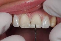 Porcelain Veneers For Gap Teeth | Cosmetic Veneers For Gap Teeth