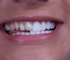 Porcelain Veneers for Straight Teeth | Dental Veneers for Straight Teeth