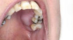 Symptoms of an Abscessed Tooth | Gum Pain | Dental Abscess Treatment