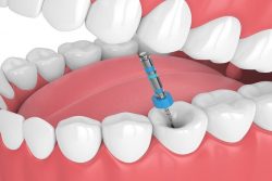 What will be the Root Canal Cost During COVID-19? | Dental Emergency
