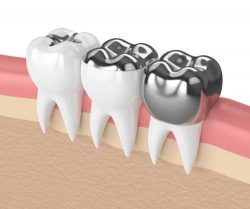 Dental Fillings & Root Canal Treatment |Overcoming Dental Fear