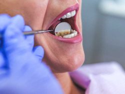 Everything You Need to Know about Dental Scaling | Emergency Dental Care