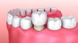 tooth crown before and after