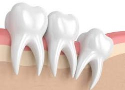 Wisdom Tooth Extraction Near Me in Houston