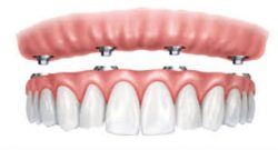 Affordable Partial Dentures Near Me