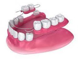 Affordable Partial Dentures in Houston, TX