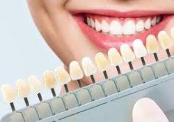 Dental Veneers Dentist Near Me