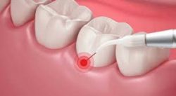 Laser Dentistry – Advanced Laser Dentistry Treatments For Cavities