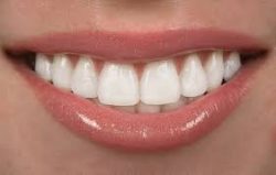 Dental Veneers Houston TX | Average Cost of Veneers