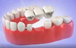 Maryland Bridge Dental | Cantilever Bridge Dental | Dental Bridge Cost