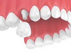 Dental Crowns And Bridges Near Me | Dentist Houston TX