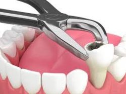 Wisdom Tooth Extraction Near Me | Surgical Tooth Extraction Cost