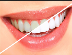 Teeth Whitening Near Me