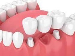 Dental Bridges Near me