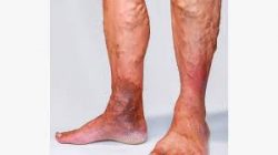 What Kind of Specialist Treats Varicose Veins?