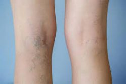 Vein Disease, Causes & Symptoms of Unhealthy Veins | Vein Clinic Of Long Island