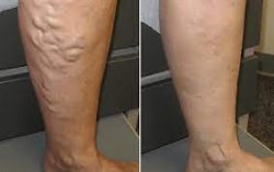 VenaSeal | Long Island Vein Treatment