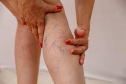 Vein Treatment Near Me | Spider and Varicose Veins Treatment New York