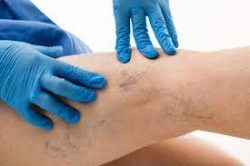 What is a vein specialist called? | Vein Doctor New Jersey