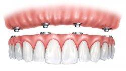 Affordable Partial Dentures in Cypress, TX