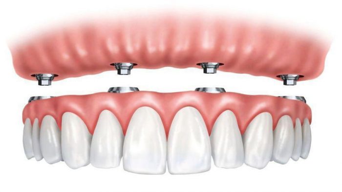 Affordable Partial Dentures in Cypress, TX