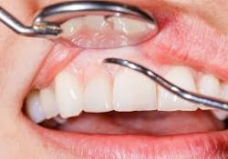 Laser Gingivectomy Treatment Near Me