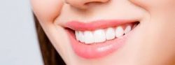 Lumineers Veneers in Houston