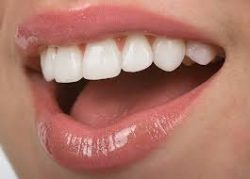 Affordable Veneers Can Give You a New Smile