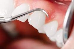 Gum Disease Treatment In Houston TX