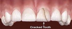 How Much Does a Tooth Filling Cost | Fix Chipped & Broken Tooth Filling