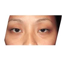 Brow Lift | Houston, TX Cosmetic Surgeon | Premiere Surgical Arts