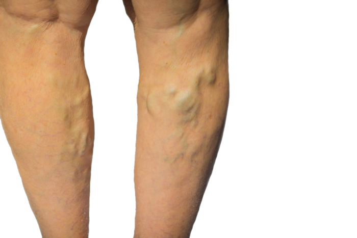 Vein Doctor long Island | Vein Specialist LI | Vein Doctor near Me