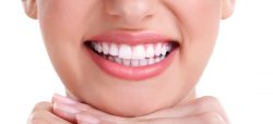How much does a top set of porcelain veneers cost? | Invisalign Cost