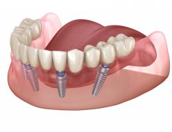How Long is Tooth Implant Recovery Process | Walk in Dentist