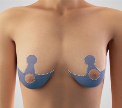 Breast Implant Revision, Augmentation, Implants Houston Texas