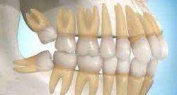 Simple Extractions & Wisdom Tooth Extractions | Dental Spa In 77084