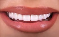 Why Do I Need Dental Veneers? | Prepping Your Teeth for Dental Veneers