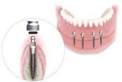 Affordable Dental Implants in Houston